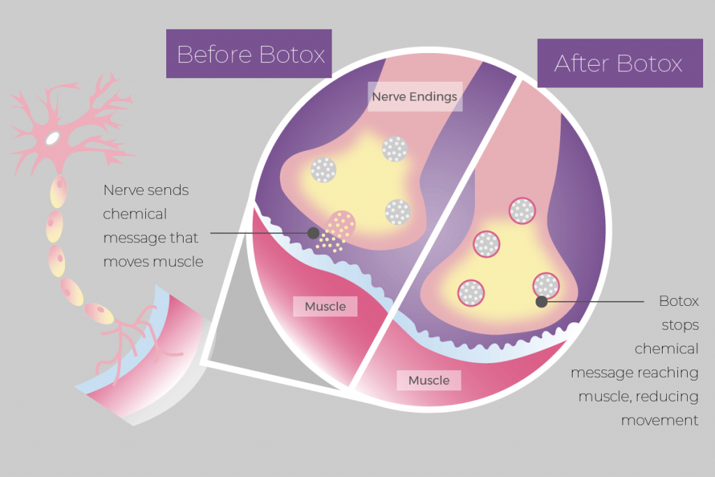 How Botox works as a neuromodulator to relax facial muscles and reduce wrinkles