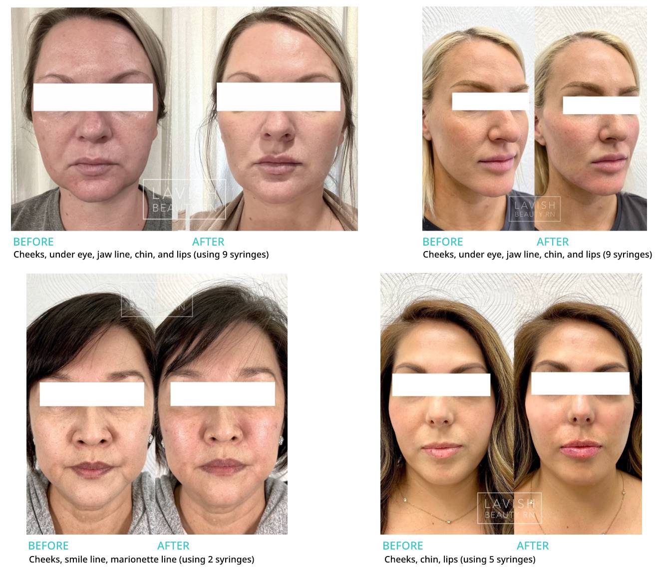 Dermal Fillers Before/After Photos