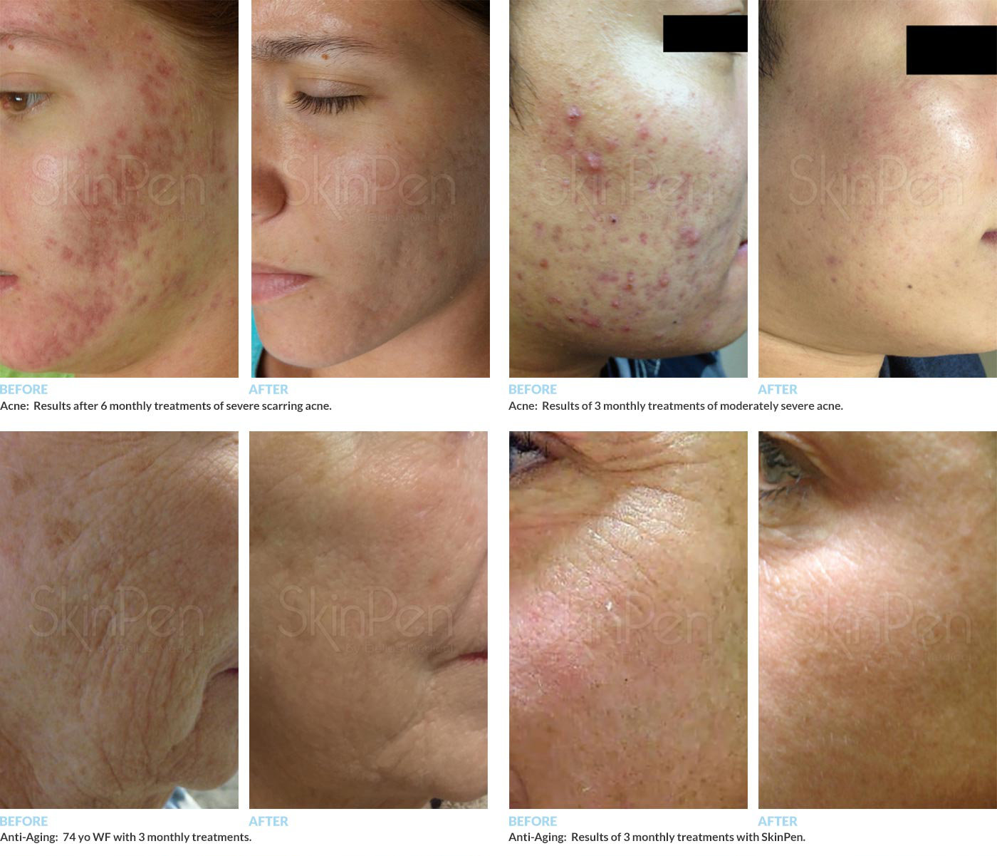 Microneedling Before/After Photos